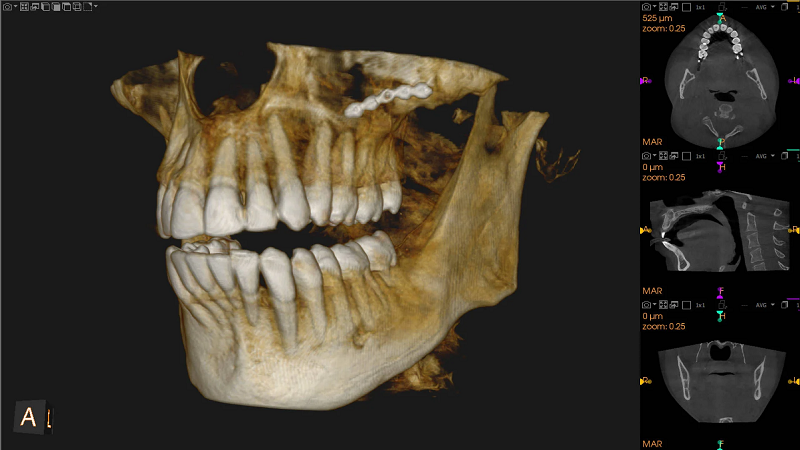 بهترین ایمپلنت اصفهان | ایمپلنت دندان سوئیسی در اصفهان | . دلیل ضرورت عکس CBCT دندان برای ایمپلنت .