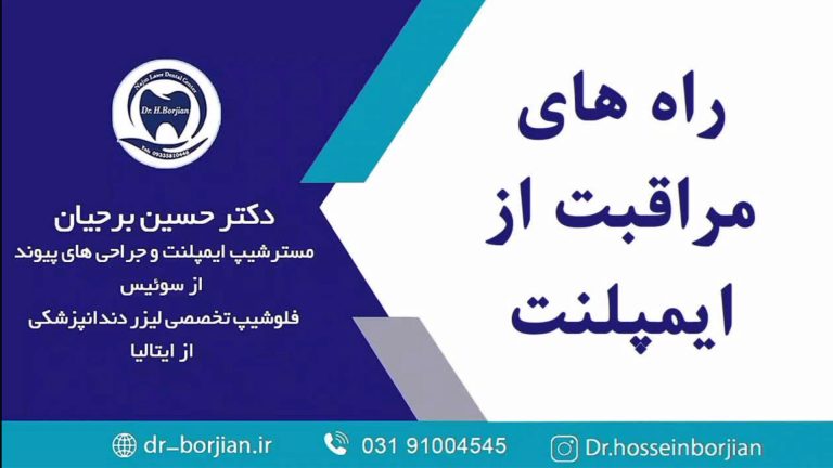 قیمت ایمپلنت اصفهان | بهترین ایمپلنت اصفهان | ایمپلنت دندان سوئیسی در اصفهان | مراقبت از ایمپلنت دندان؛ راز موفقیت درمان شما!