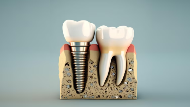 قیمت ایمپلنت اصفهان | بهترین ایمپلنت اصفهان | ایمپلنت دندان سوئیسی در اصفهان | ایمپلنت یک روزه