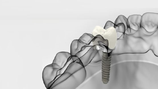 قیمت ایمپلنت اصفهان | بهترین ایمپلنت اصفهان | ایمپلنت دندان سوئیسی در اصفهان | آگاهی از برتری‌های ایمپلنت دیجیتال