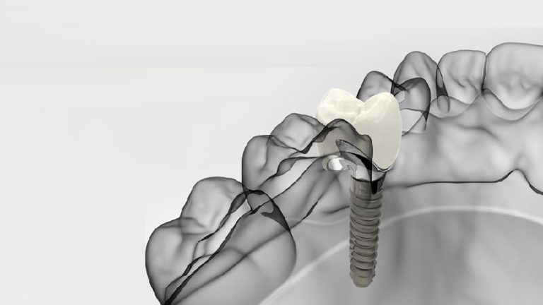 قیمت ایمپلنت اصفهان | بهترین ایمپلنت اصفهان | ایمپلنت دندان سوئیسی در اصفهان | آگاهی از برتری‌های ایمپلنت دیجیتال