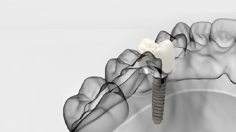 قیمت ایمپلنت اصفهان | بهترین ایمپلنت اصفهان | ایمپلنت دندان سوئیسی در اصفهان | 
 آگاهی از برتری‌های ایمپلنت دیجیتال