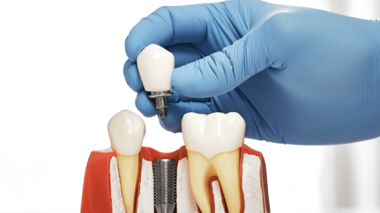 قیمت ایمپلنت اصفهان | بهترین ایمپلنت اصفهان | ایمپلنت دندان سوئیسی در اصفهان | تفاوت قیمت ایمپلنت یک روزه با ایمپلنت معمول