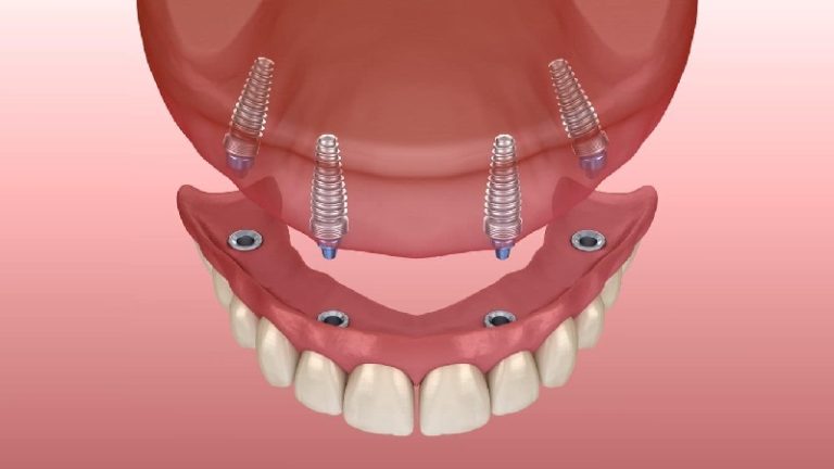 قیمت ایمپلنت اصفهان | بهترین ایمپلنت اصفهان | ایمپلنت دندان سوئیسی در اصفهان | علل رایج برای جایگزینی دندان مصنوعی متحرک به ایمپلنت دندان .