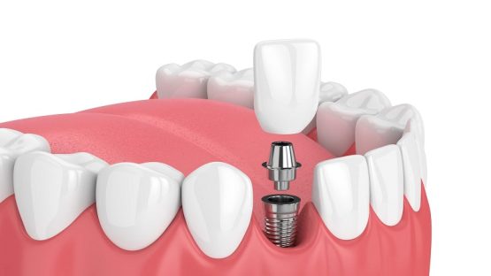 قیمت ایمپلنت اصفهان | بهترین ایمپلنت اصفهان | ایمپلنت دندان سوئیسی در اصفهان | فواید کاشت ایمپلنت دندان جلو چیست ؟
