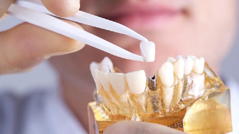 قیمت ایمپلنت اصفهان | بهترین ایمپلنت اصفهان | ایمپلنت دندان سوئیسی در اصفهان | نگهداری و اقدامات لازم در زمان افتادن روکش ایمپلنت دندان