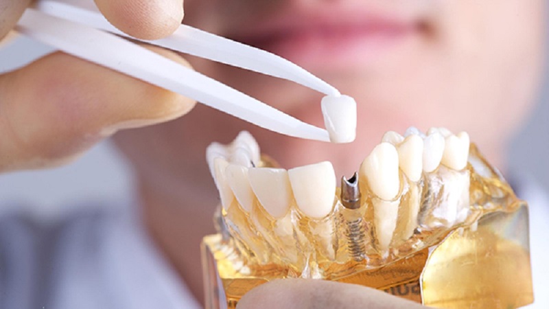 قیمت ایمپلنت اصفهان | بهترین ایمپلنت اصفهان | ایمپلنت دندان سوئیسی در اصفهان | نگهداری و اقدامات لازم در زمان افتادن روکش ایمپلنت دندان