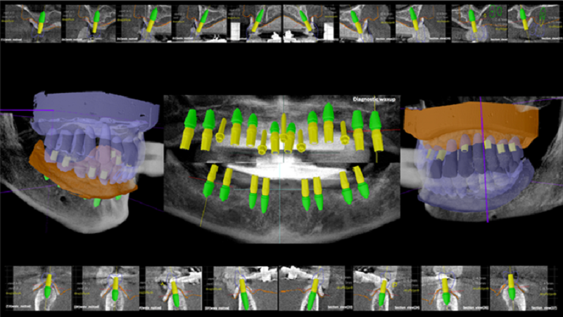 قیمت ایمپلنت اصفهان | بهترین ایمپلنت اصفهان | ایمپلنت دندان سوئیسی در اصفهان | کاشت ایمپلنت دیجیتال