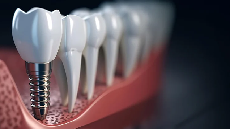 قیمت ایمپلنت اصفهان | بهترین ایمپلنت اصفهان | ایمپلنت دندان سوئیسی در اصفهان | 10 علت تفاوت قیمت ایمپلنت های دندانپ