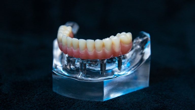 قیمت ایمپلنت اصفهان | بهترین ایمپلنت اصفهان | ایمپلنت دندان سوئیسی در اصفهان | 11 نکته از کاشت ایمپلنت دندان All-On-4 که باید در نظر گرفت!!!