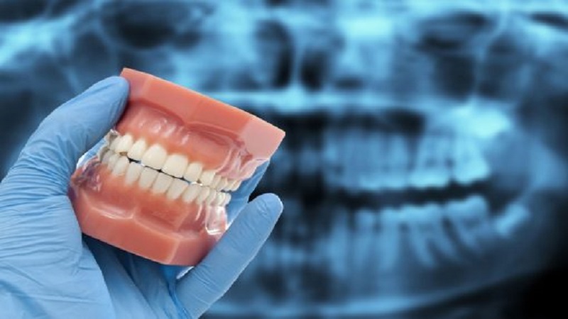 قیمت ایمپلنت اصفهان | بهترین ایمپلنت اصفهان | ایمپلنت دندان سوئیسی در اصفهان |  7 مزیت برجسته ایمپلنت های فول موس