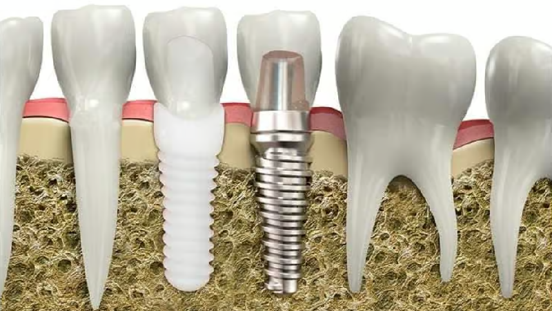 قیمت ایمپلنت اصفهان | بهترین ایمپلنت اصفهان | ایمپلنت دندان سوئیسی در اصفهان | ایمپلنت تیتانیوم - ایمپلنت زیرکونیا
