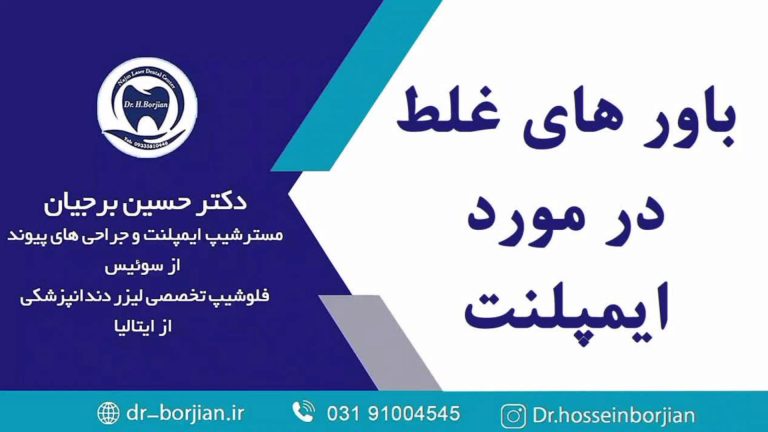 قیمت ایمپلنت اصفهان | بهترین ایمپلنت اصفهان | ایمپلنت دندان سوئیسی در اصفهان | باورهای غلط درباره ایمپلنت