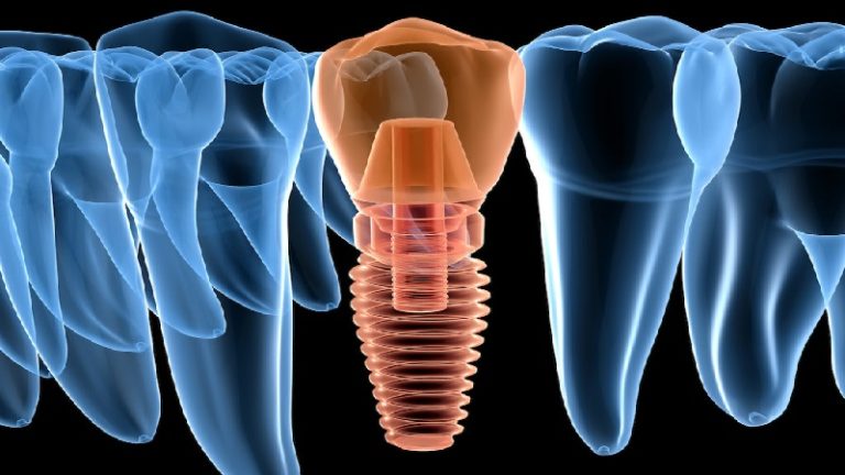 قیمت ایمپلنت اصفهان | بهترین ایمپلنت اصفهان | ایمپلنت دندان سوئیسی در اصفهان | جدا شدن ایمپلنت دندان از استخوان فک
