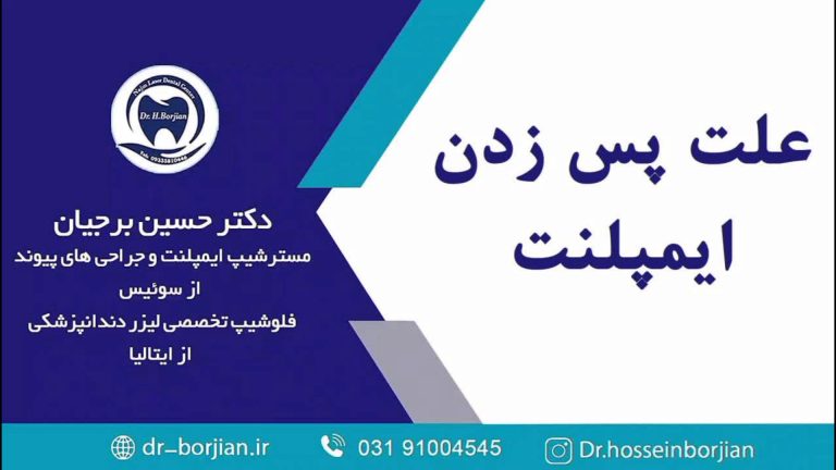 قیمت ایمپلنت اصفهان | بهترین ایمپلنت اصفهان | ایمپلنت دندان سوئیسی در اصفهان | علت پس زدن ایمپلنت‌ها و نکات مهمی که باید بدانید!