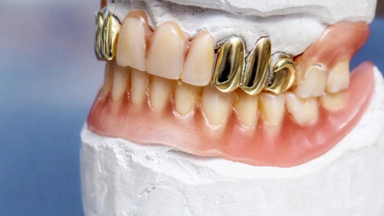 قیمت ایمپلنت اصفهان | بهترین ایمپلنت اصفهان | ایمپلنت دندان سوئیسی در اصفهان | مد ، دنیای مدرن و ایمپلنت دندان طلا