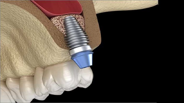 قیمت ایمپلنت اصفهان | بهترین ایمپلنت اصفهان | ایمپلنت دندان سوئیسی در اصفهان | مراقبت‌های لازم بعد از جراحی سینوس لیفت