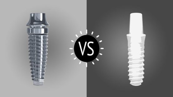 قیمت ایمپلنت اصفهان | بهترین ایمپلنت اصفهان | ایمپلنت دندان سوئیسی در اصفهان | مزایا و معایب ایمپلنت تیتانیومی و ایمپلنت زیرکونیا