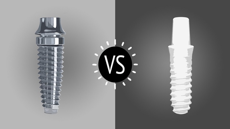 قیمت ایمپلنت اصفهان | بهترین ایمپلنت اصفهان | ایمپلنت دندان سوئیسی در اصفهان | مزایا و معایب ایمپلنت تیتانیومی و ایمپلنت زیرکونیا