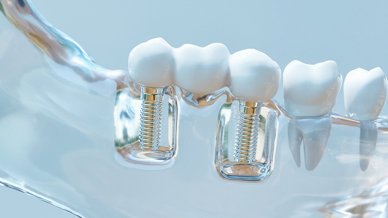 قیمت ایمپلنت اصفهان | بهترین ایمپلنت اصفهان | ایمپلنت دندان سوئیسی در اصفهان | مینی ایمپلنت ها و هزینه کاشت آن