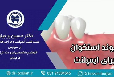 قیمت ایمپلنت اصفهان | بهترین ایمپلنت اصفهان | ایمپلنت دندان سوئیسی در اصفهان | پیوند استخوان لثه: مراحل انجام و زمان بهبودی