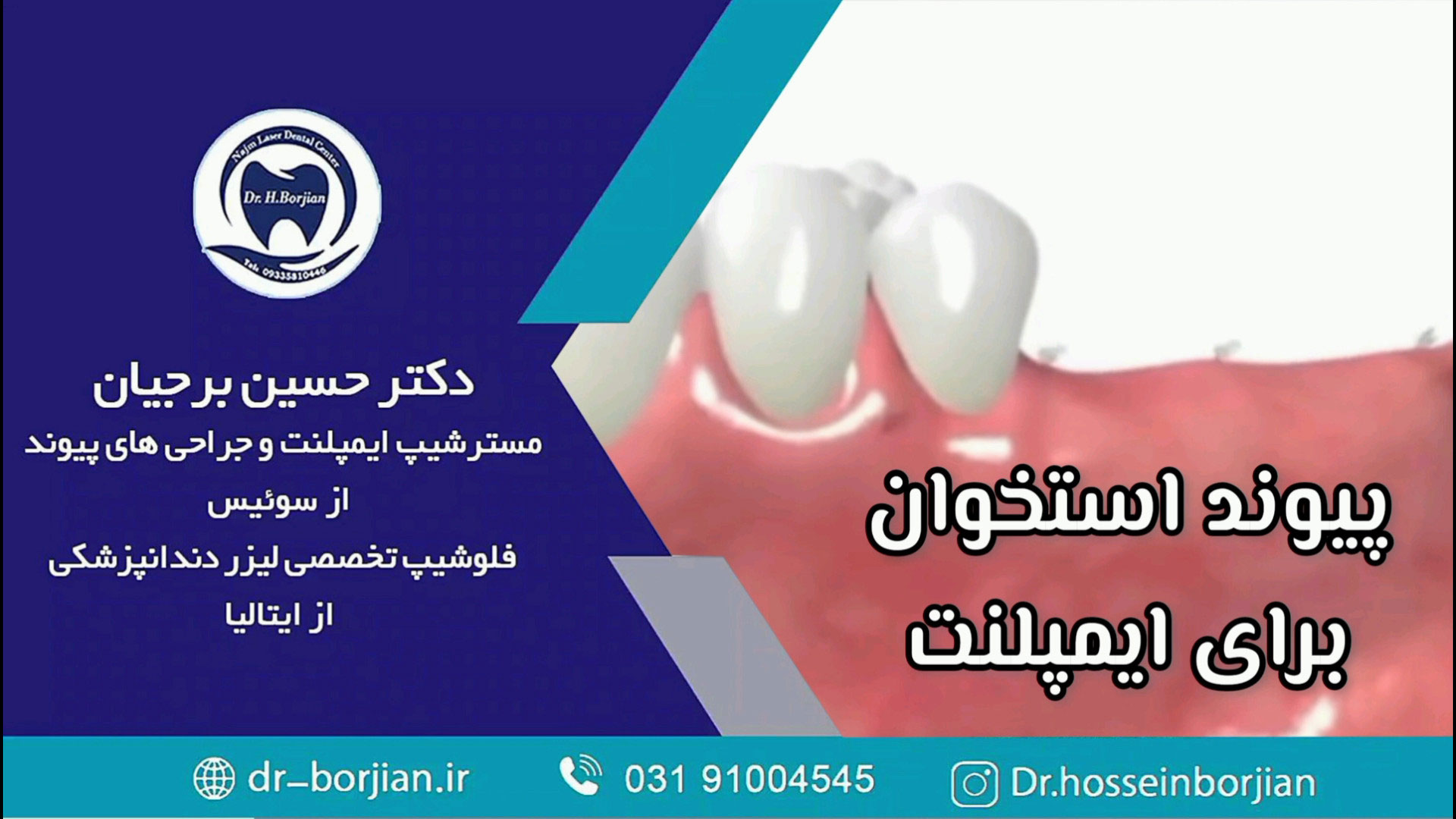 قیمت ایمپلنت اصفهان | بهترین ایمپلنت اصفهان | ایمپلنت دندان سوئیسی در اصفهان | پیوند استخوان لثه: مراحل انجام و زمان بهبودی