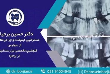 قیمت ایمپلنت اصفهان | بهترین ایمپلنت اصفهان | ایمپلنت دندان سوئیسی در اصفهان | کاشت ایمپلنت در فک بالا