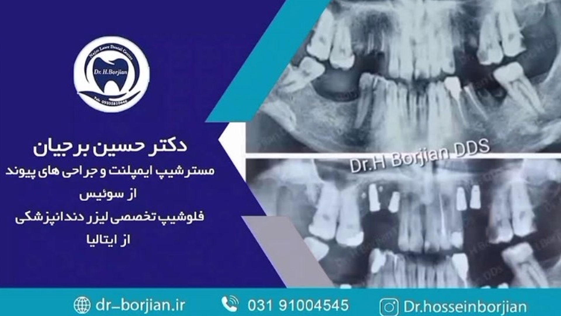 قیمت ایمپلنت اصفهان | بهترین ایمپلنت اصفهان | ایمپلنت دندان سوئیسی در اصفهان | کاشت ایمپلنت در فک بالا