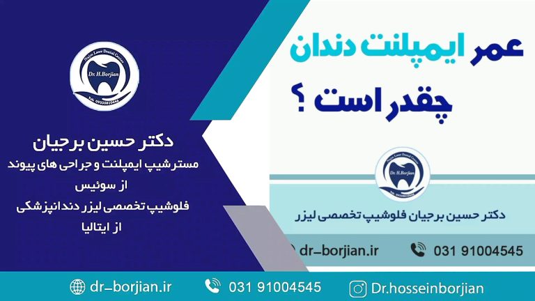 قیمت ایمپلنت اصفهان | بهترین ایمپلنت اصفهان | ایمپلنت دندان سوئیسی در اصفهان |