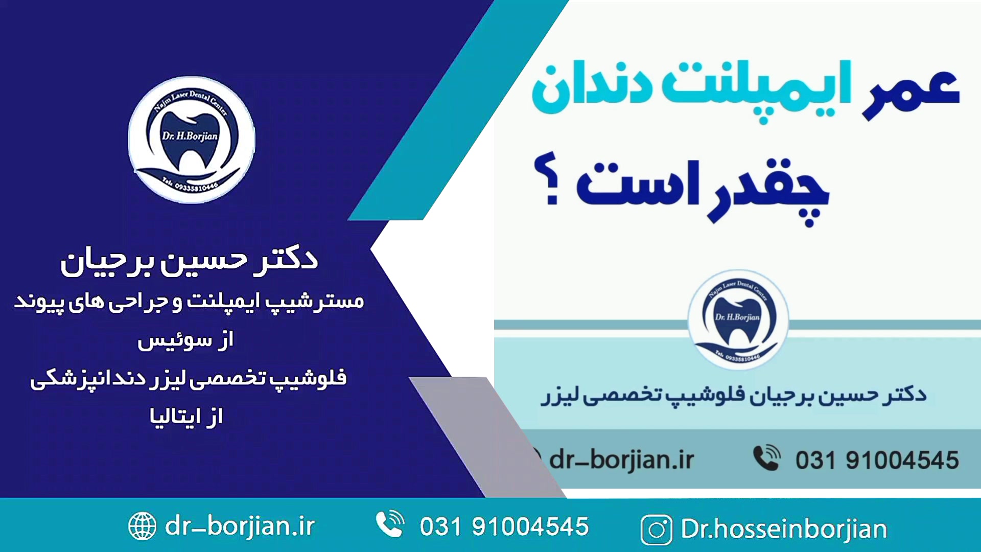 قیمت ایمپلنت اصفهان | بهترین ایمپلنت اصفهان | ایمپلنت دندان سوئیسی در اصفهان |