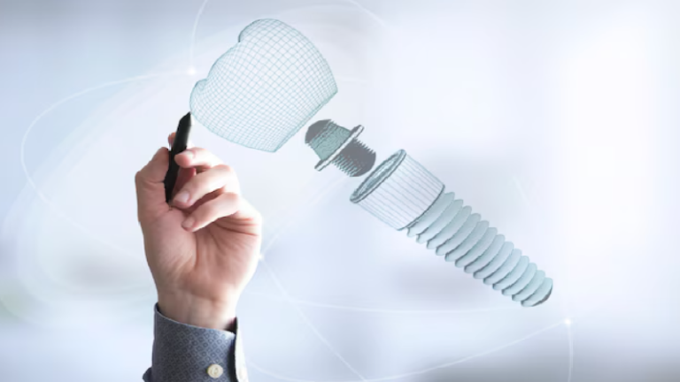 قیمت ایمپلنت اصفهان | بهترین ایمپلنت اصفهان | ایمپلنت دندان سوئیسی در اصفهان | Dental Implant Dentist