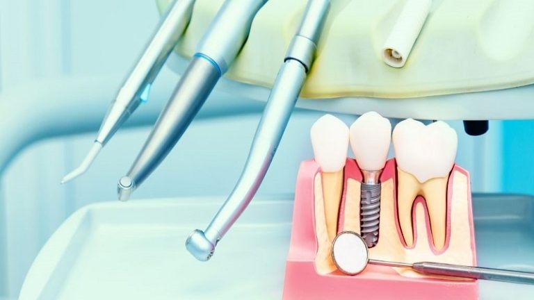 قیمت ایمپلنت اصفهان | بهترین ایمپلنت اصفهان | ایمپلنت دندان سوئیسی در اصفهان | بهترین ایمپلنت اصفهان دکتر حسین برجیان