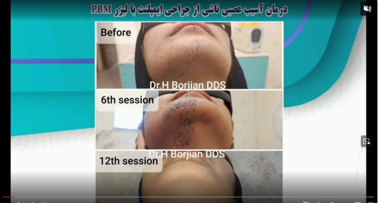 قیمت ایمپلنت اصفهان | بهترین ایمپلنت اصفهان | ایمپلنت دندان سوئیسی در اصفهان | ویدئو آپارات درمان آسیب عصبی ناشی از جراحی ایمپلنت با لیزر PBM