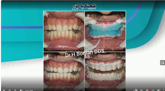 قیمت ایمپلنت اصفهان | بهترین ایمپلنت اصفهان | ایمپلنت دندان سوئیسی در اصفهان | بلیچینگ با لیزر دکتر حسین برجیان بهتریم متخصص ایمپلنت اصفهان