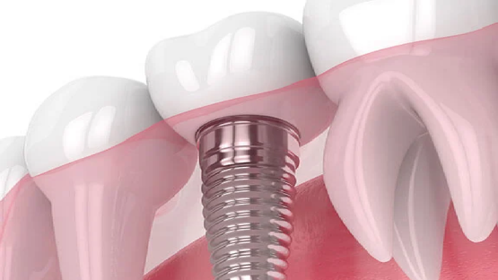 قیمت ایمپلنت اصفهان | بهترین ایمپلنت اصفهان | ایمپلنت دندان سوئیسی در اصفهان | آشنایی با ویژگی‌ها و قیمت ایمپلنت اشترومن 