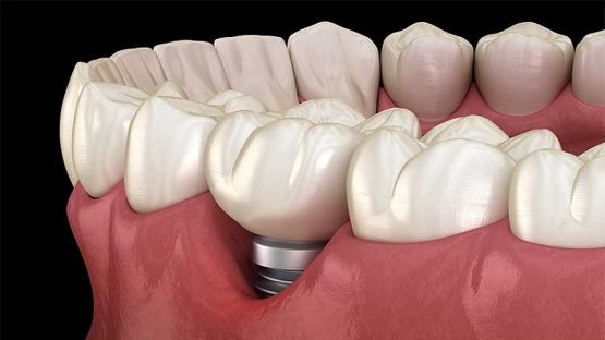 قیمت ایمپلنت اصفهان | بهترین ایمپلنت اصفهان | ایمپلنت دندان سوئیسی در اصفهان | تحلیل لثه پس از کاشت ایمپلنت با نگاهی دقیق و علمی