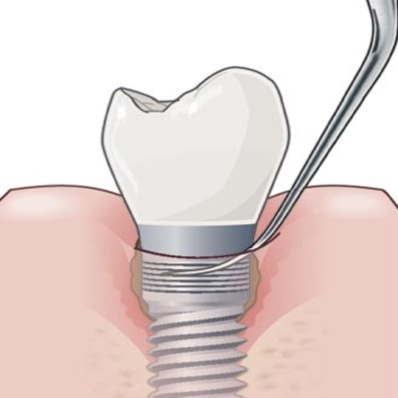 قیمت ایمپلنت اصفهان | بهترین ایمپلنت اصفهان | ایمپلنت دندان سوئیسی در اصفهان | جرم‌ گیری ایمپلنت دندان چه مزایایی دارد؟ .