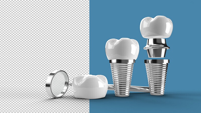 قیمت ایمپلنت اصفهان | بهترین ایمپلنت اصفهان | ایمپلنت دندان سوئیسی در اصفهان | هزینه کاشت ایمپلنت زیمر آمریکا چقدر است ؟