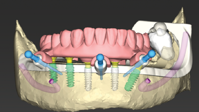 قیمت ایمپلنت اصفهان | بهترین ایمپلنت اصفهان | ایمپلنت دندان سوئیسی در اصفهان | استفاده از ایمپلنت دیجیتال به ‎جای ایمپلنت معمولی