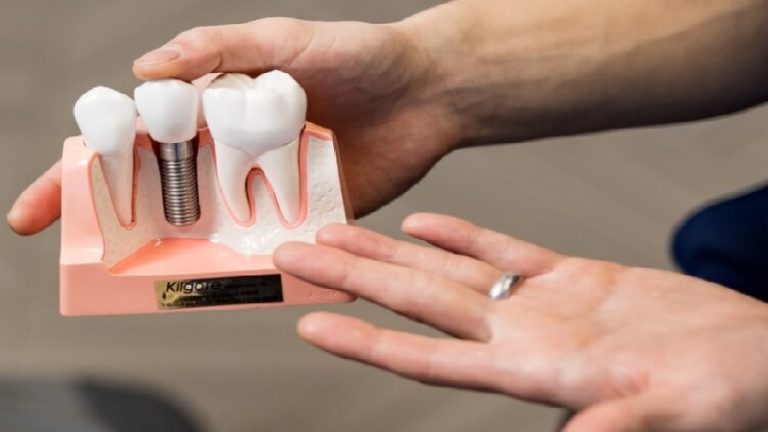 قیمت ایمپلنت اصفهان | بهترین ایمپلنت اصفهان | ایمپلنت دندان سوئیسی در اصفهان |  ایمپلنت دندان در بیماران نقص‌ های مادرزادی