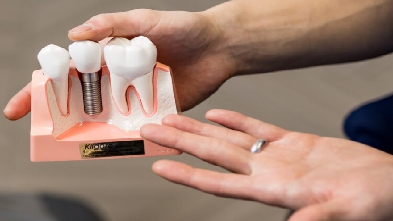 قیمت ایمپلنت اصفهان | بهترین ایمپلنت اصفهان | ایمپلنت دندان سوئیسی در اصفهان |  ایمپلنت دندان در بیماران نقص‌ های مادرزادی