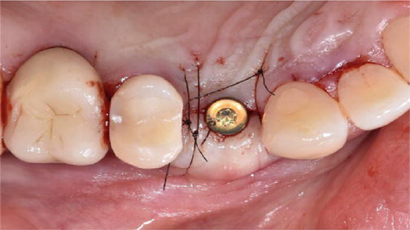 قیمت ایمپلنت اصفهان | بهترین ایمپلنت اصفهان | ایمپلنت دندان سوئیسی در اصفهان | بخیه ایمپلنت دندان و دانستنی آن