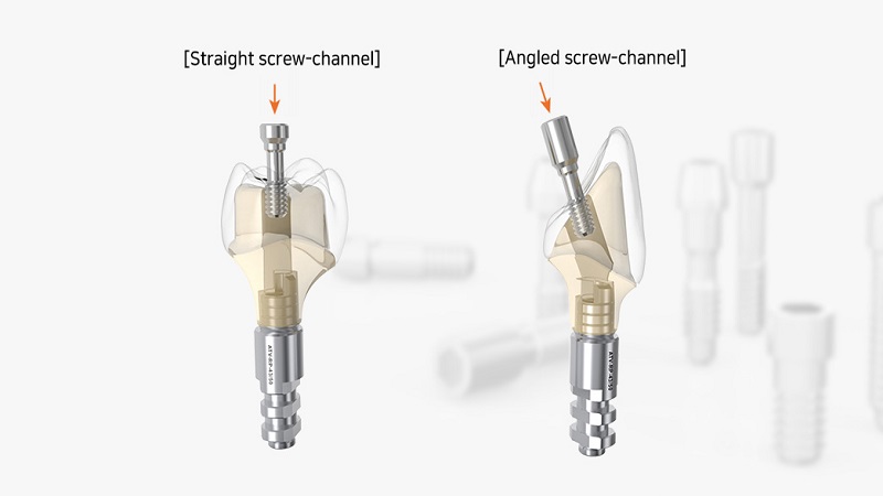  قیمت ایمپلنت اصفهان | بهترین ایمپلنت اصفهان | ایمپلنت دندان سوئیسی در اصفهان | دلایل استفاده از ایمپلنت دندان زاویه‌دار .