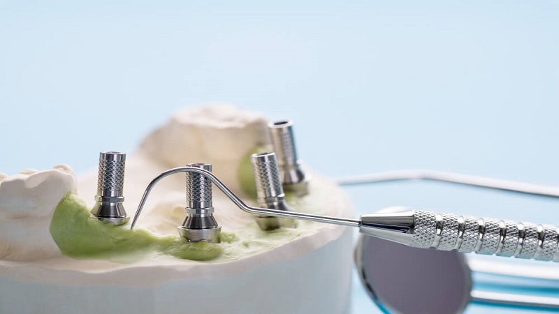 قیمت ایمپلنت اصفهان | بهترین ایمپلنت اصفهان | ایمپلنت دندان سوئیسی در اصفهان | . دلایل استفاده از ایمپلنت دندان زاویه‌دار .