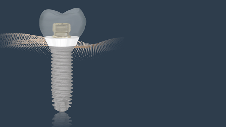 قیمت ایمپلنت اصفهان | بهترین ایمپلنت اصفهان | ایمپلنت دندان سوئیسی در اصفهان | کاربرد ایمپلنت فرانسوی دندان چه مزایایی دارد؟