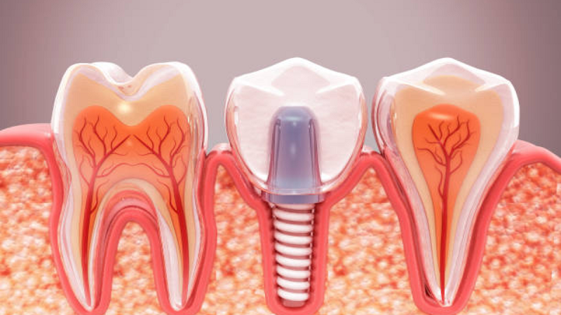 قیمت ایمپلنت اصفهان | بهترین ایمپلنت اصفهان | ایمپلنت دندان سوئیسی در اصفهان | 7 نکته برای مراقبت های بعد از ایمپلنت