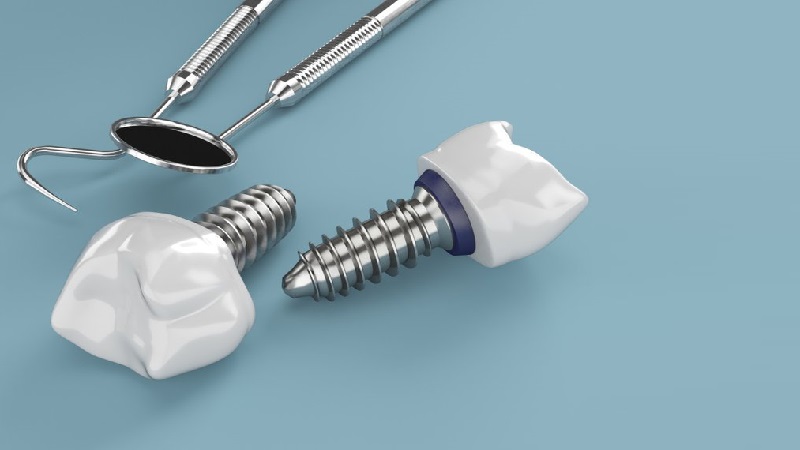 قیمت ایمپلنت اصفهان | بهترین ایمپلنت اصفهان | ایمپلنت دندان سوئیسی در اصفهان | همه چیز درباره گارانتی ایمپلنت دندان