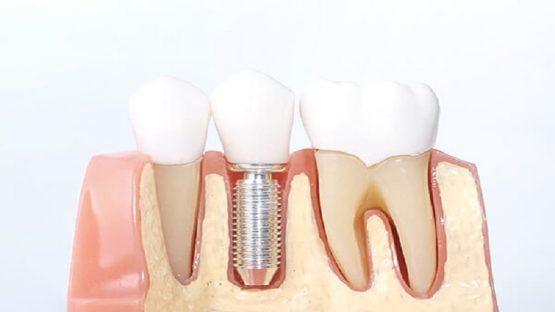 قیمت ایمپلنت اصفهان | بهترین ایمپلنت اصفهان | ایمپلنت دندان سوئیسی در اصفهان | بهترین روکش دندان برای ایمپلنت