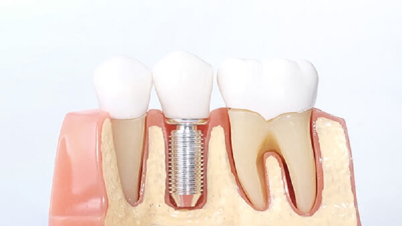 قیمت ایمپلنت اصفهان | بهترین ایمپلنت اصفهان | ایمپلنت دندان سوئیسی در اصفهان | بهترین روکش دندان برای ایمپلنت