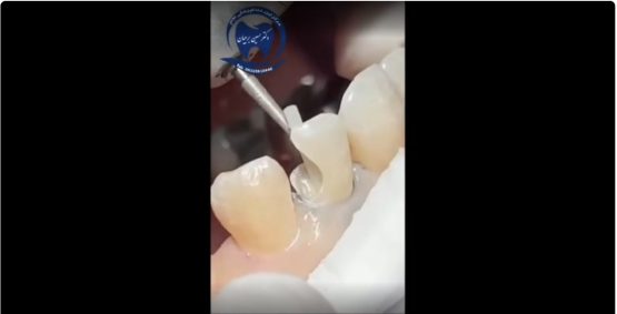 قیمت ایمپلنت اصفهان | بهترین ایمپلنت اصفهان | ایمپلنت دندان سوئیسی در اصفهان | کامپوزیت با بهترین متخصص دندانپزشکی اصفهان دکتر حسین برجیان